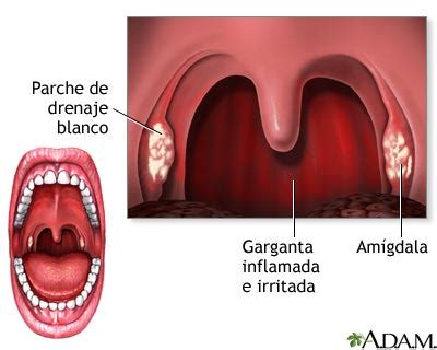 Amigdalitis estreptocócica .